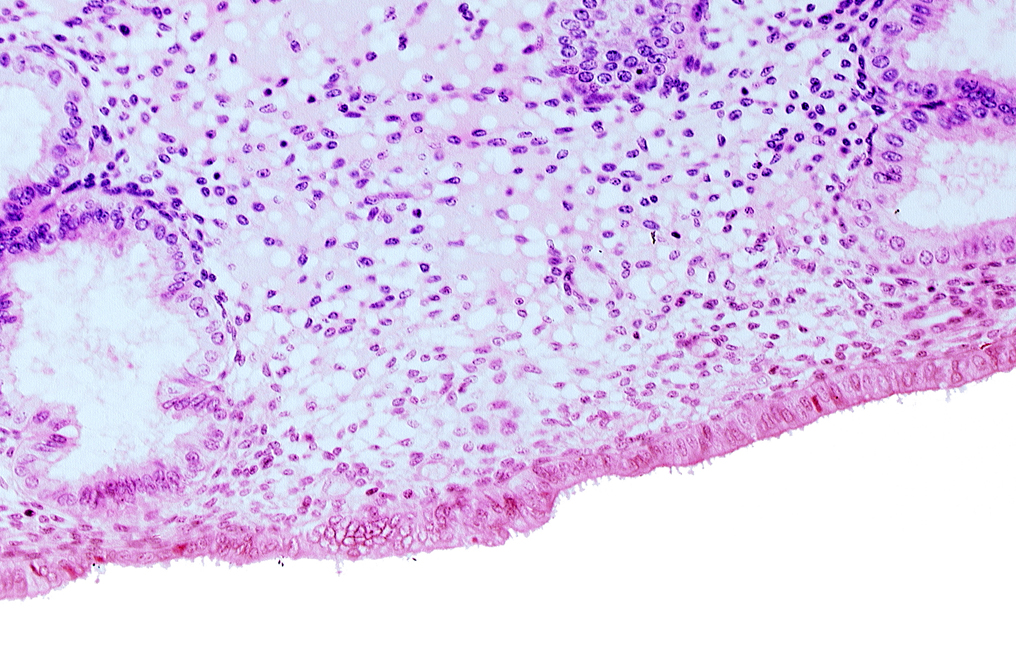 disrupted endometrial epithelium, endometrial epithelium, lumen of endometrial gland