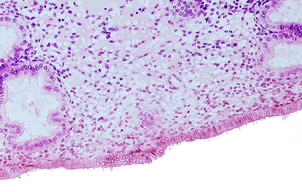 disrupted endometrial epithelium, edematous endometrial stroma (decidua), endometrial epithelium, lumen of endometrial gland