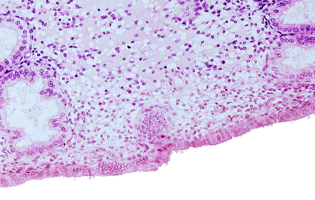 disrupted endometrial epithelium, endometrial epithelium, endometrial gland, lumen of endometrial gland