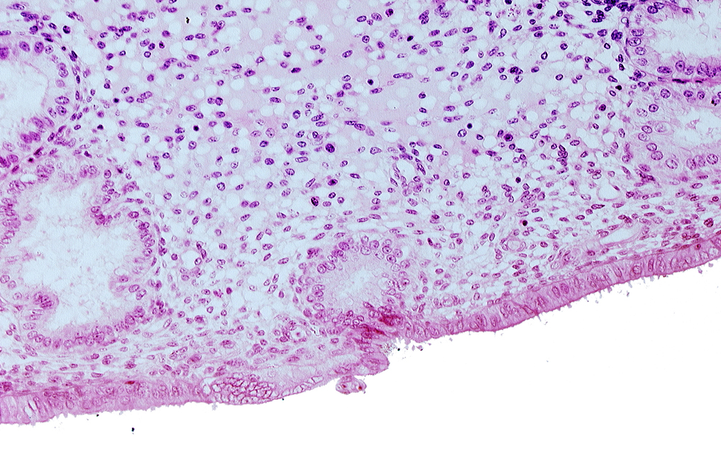 disrupted endometrial epithelium, edematous endometrial stroma (decidua), endometrial epithelium, endometrial gland