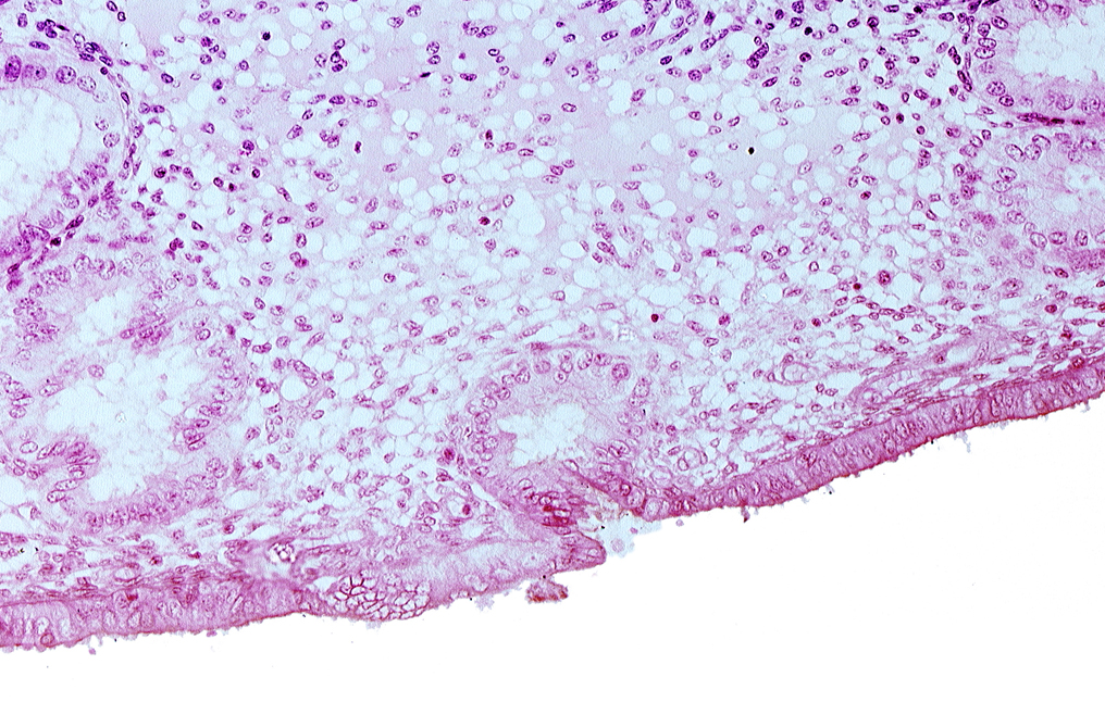 disrupted endometrial epithelium, edematous endometrial stroma (decidua), endometrial epithelium, lumen of endometrial gland