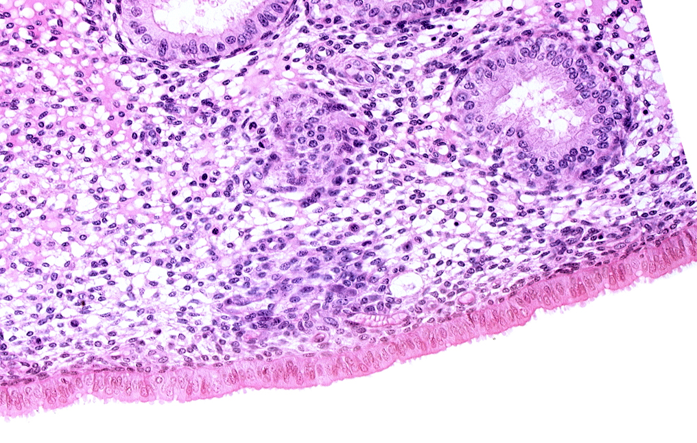 edematous endometrial stroma (decidua), edge of endometrial gland, edge of syncytiotrophoblast, endometrial sinusoid, intact endometrial epithelium