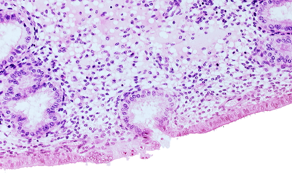 disrupted endometrial epithelium, edematous endometrial stroma (decidua), endometrial epithelium, lumen of endometrial gland