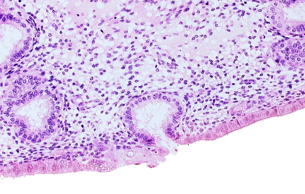 disrupted endometrial epithelium, edge of solid syncytiotrophoblast, endometrial epithelium, lumen of endometrial gland, mouth of endometrial gland