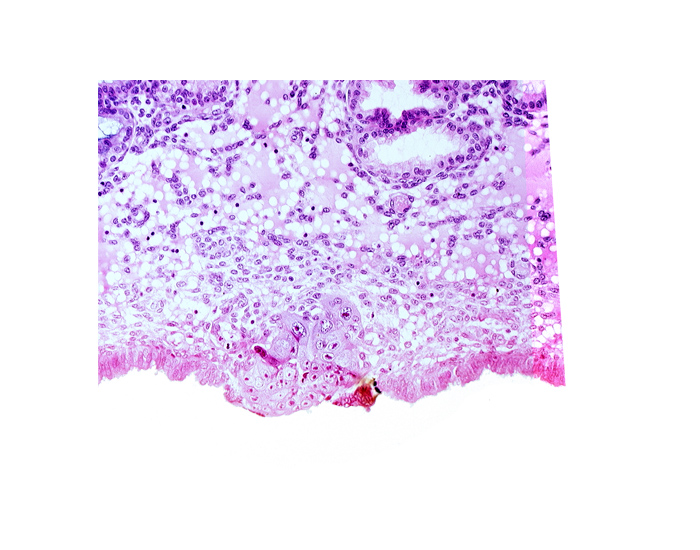 cytotrophoblast, edematous endometrial stroma (decidua), endometrial epithelium, syncytiotrophoblast