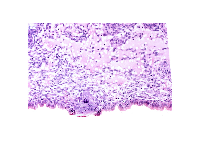 cytotrophoblast, edematous endometrial stroma (decidua), endometrial epithelium, endometrial sinusoid, membranous trophoblast at abembryonic pole