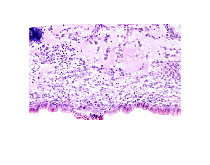cytotrophoblast, edematous endometrial stroma (decidua), endometrial epithelium, uterine cavity