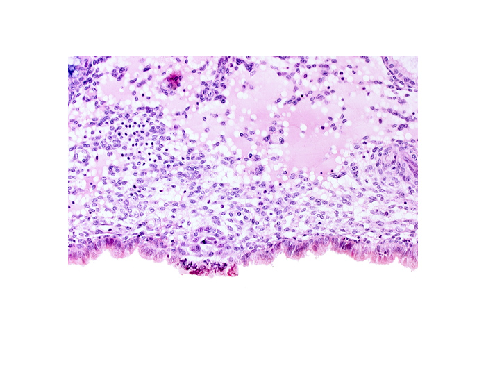 edematous endometrial stroma (decidua), edge of cytotrophoblast, endometrial epithelium