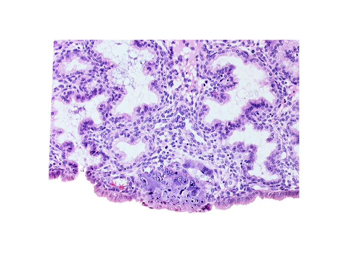 cytotrophoblast, endometrial epithelium, endometrial sinusoid, endometrial stroma (decidua), mouth of adjacent endometrial gland, solid syncytiotrophoblast