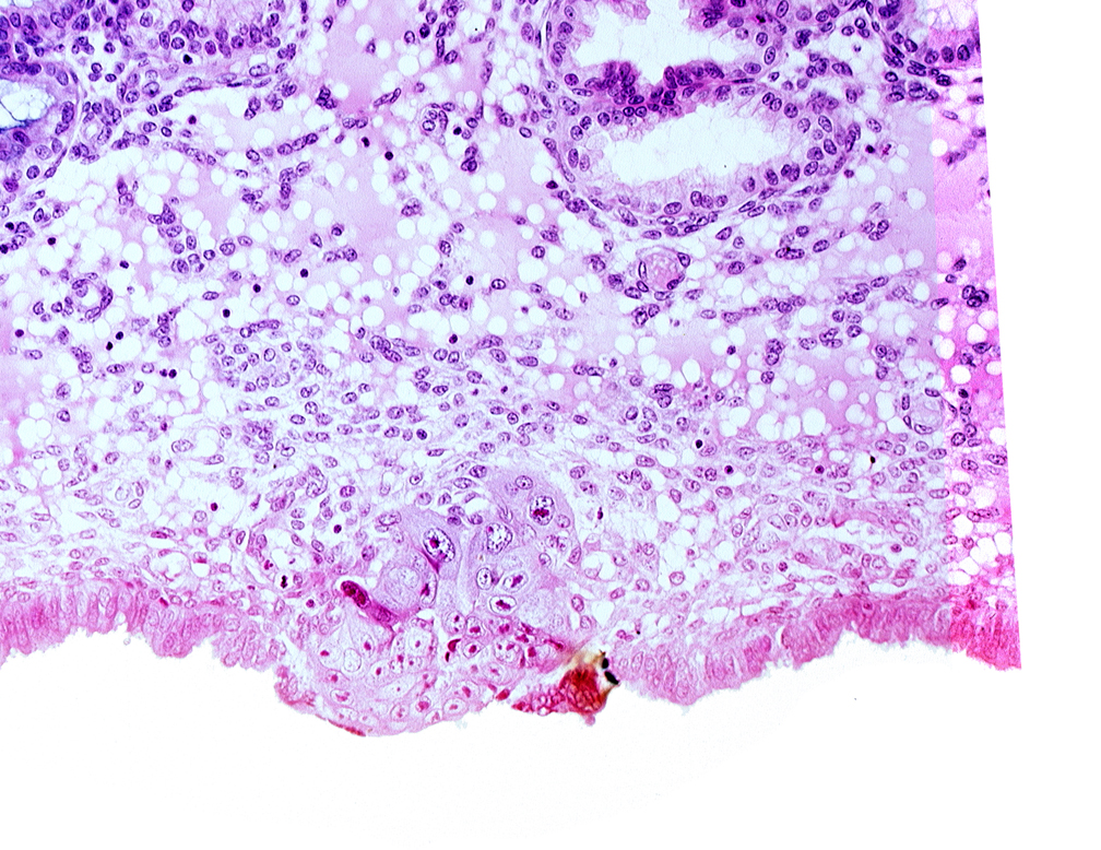 cytotrophoblast, edematous endometrial stroma (decidua), endometrial epithelium, syncytiotrophoblast