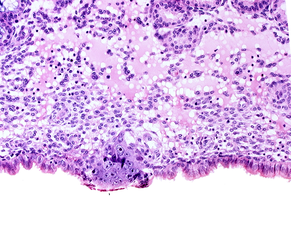 cytotrophoblast, edematous endometrial stroma (decidua), endometrial epithelium, endometrial sinusoid, membranous trophoblast at abembryonic pole