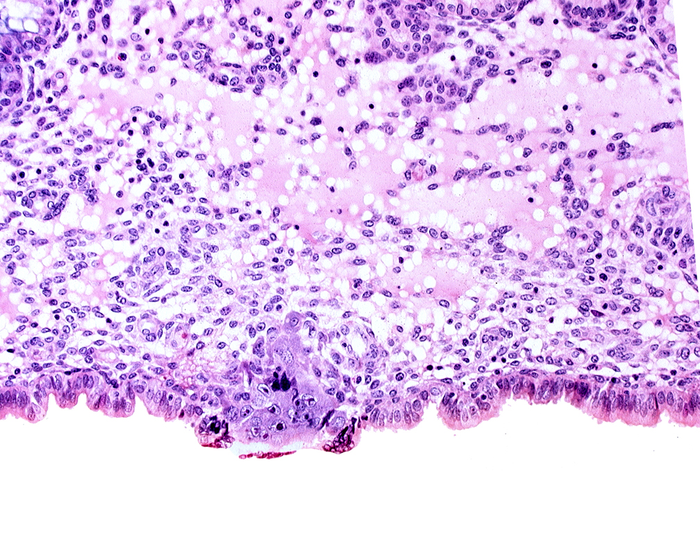 cytotrophoblast, edematous endometrial stroma (decidua), endometrial epithelium, endometrial sinusoid, membranous trophoblast at abembryonic pole