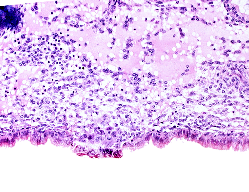 cytotrophoblast, edematous endometrial stroma (decidua), endometrial epithelium, uterine cavity