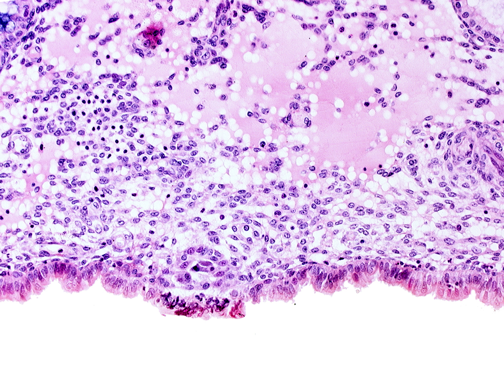 edematous endometrial stroma (decidua), edge of cytotrophoblast, endometrial epithelium