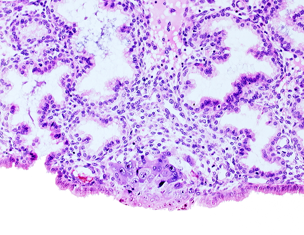 endometrial epithelium, lumen of adjacent endometrial gland, mouth of endometrial gland, solid syncytiotrophoblast