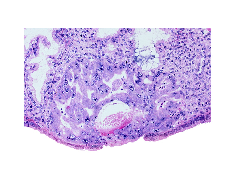 cytotrophoblast, disrupted endometrial epithelium, extra-embryonic mesoblast, intact endometrial epithelium, lumen of endometrial gland, primary umbilical vesicle cavity