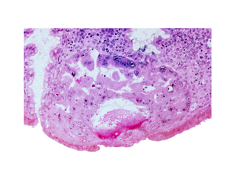 endometrial sinusoid, lumen of endometrial gland, maternal blood cells in primary umbilical vesicle cavity, mouth of endometrial gland