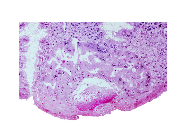 cytotrophoblast, disrupted endometrial epithelium, endometrial sinusoid, junction of endometrial sinusoid and trophoblastic lacuna, lumen of endometrial gland, maternal blood cells in primary umbilical vesicle cavity, mouth of endometrial gland, syncytiotrophoblast