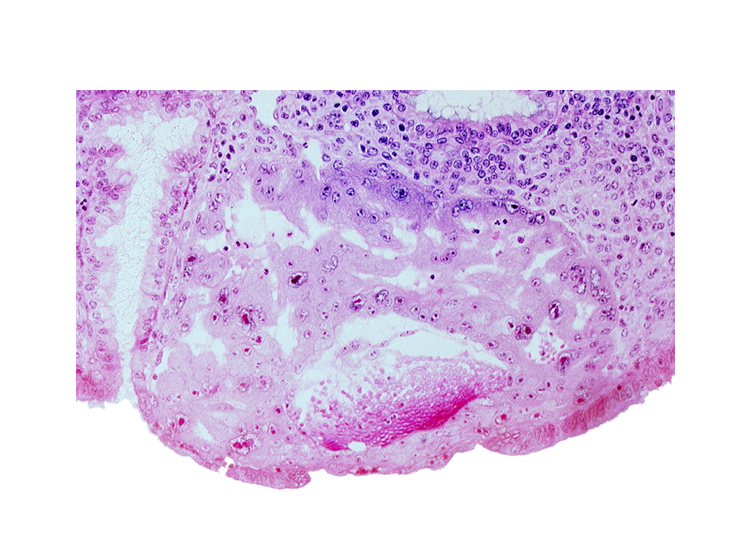 disrupted endometrial epithelium, extra-embryonic endoblast, intact endometrial epithelium, intercommunicating lacunae