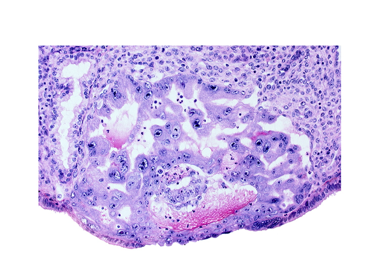 amniotic cavity, disrupted endometrial epithelium, uterine cavity