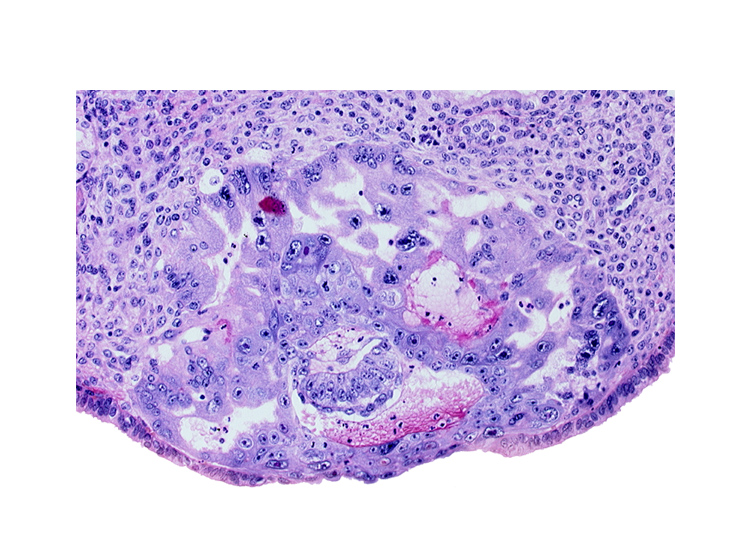 amnioblast(s), amniotic cavity, cytotrophoblast, disrupted endometrial epithelium, endometrial sinusoid, epiblast, intact endometrial epithelium, intercommunicating trophoblastic lacunae, syncytiotrophoblast, uterine cavity