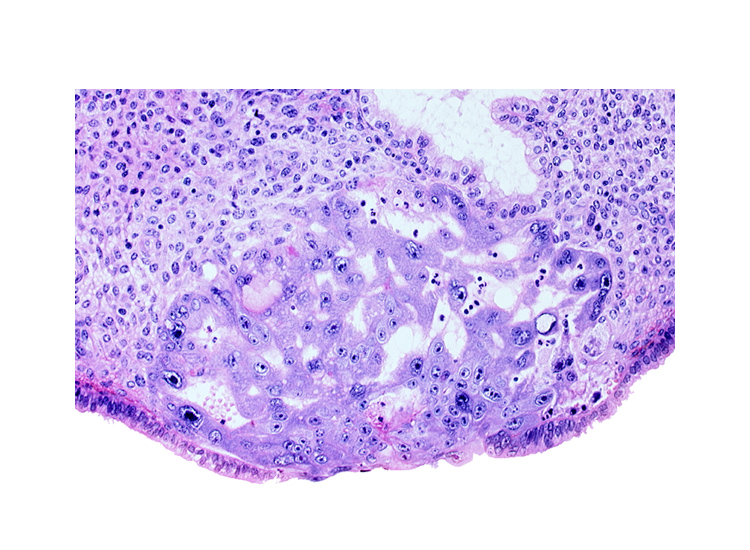 disrupted endometrial epithelium, intact endometrial epithelium, intercommunicating lacunae, lumen of endometrial gland