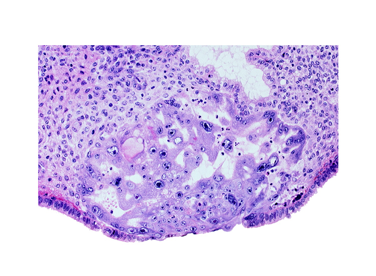 cytotrophoblast, disrupted endometrial epithelium, endometrial stroma, intact endometrial epithelium, intercommunicating lacunae, lumen of endometrial gland, syncytiotrophoblast