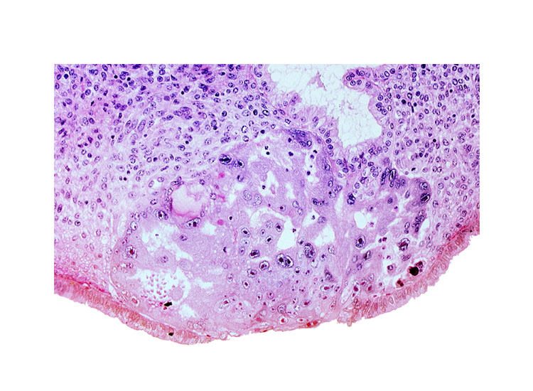 disrupted endometrial epithelium, edematous endometrial stroma (decidua), endometrial gland, intact endometrial epithelium, syncytiotrophoblast, uterine cavity