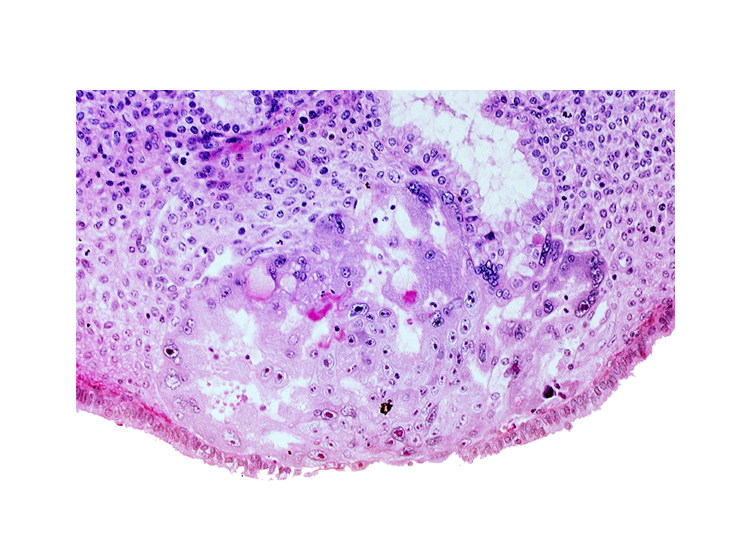 disrupted endometrial epithelium, intercommunicating lacunae, lumen of endometrial gland, syncytiotrophoblast, uterine cavity