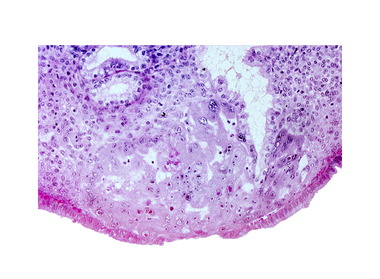 disrupted endometrial epithelium, endometrial epithelium, endometrial gland, lumen of endometrial gland