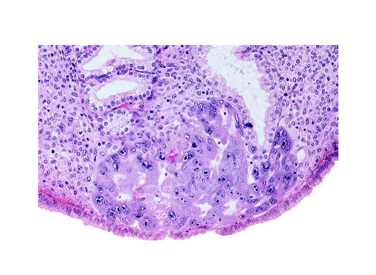 disrupted endometrial epithelium, endometrial epithelium, endometrial gland, intercommunicating lacunae, syncytiotrophoblast