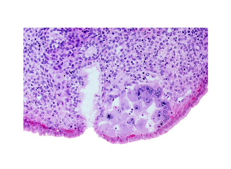 edematous endometrial stroma (decidua), intact endometrial epithelium, maternal blood cells in lacunae, mouth of endometrial gland, syncytiotrophoblast, uterine cavity