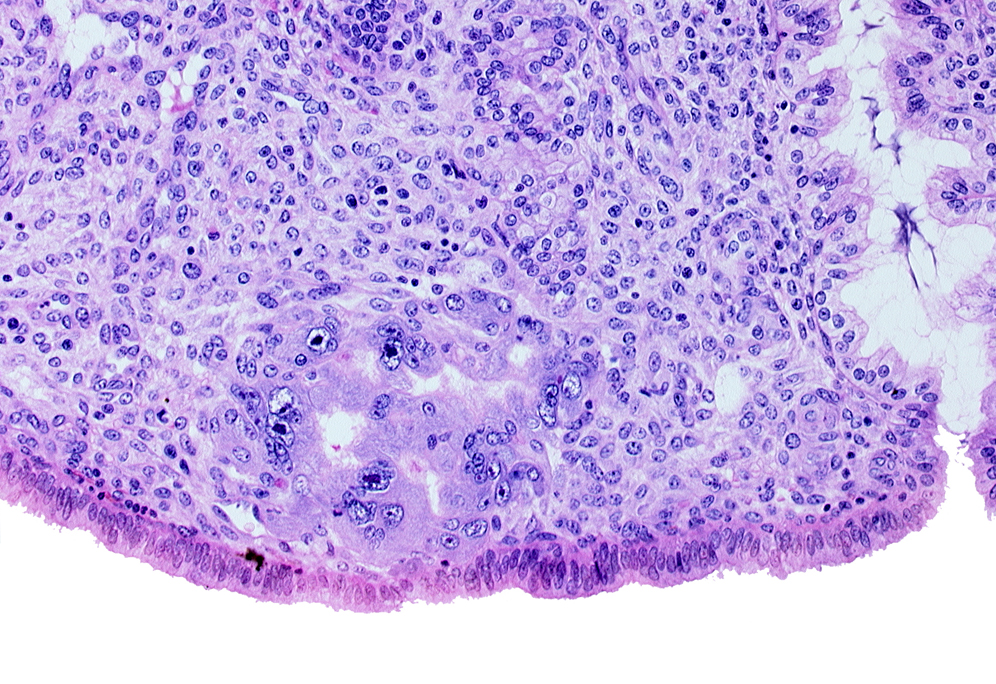 endometrial sinusoid, intact endometrial epithelium, uterine cavity