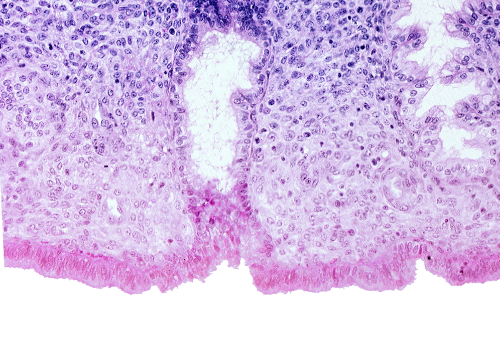 edematous endometrial stroma (decidua), endometrial sinusoid, intact endometrial epithelium