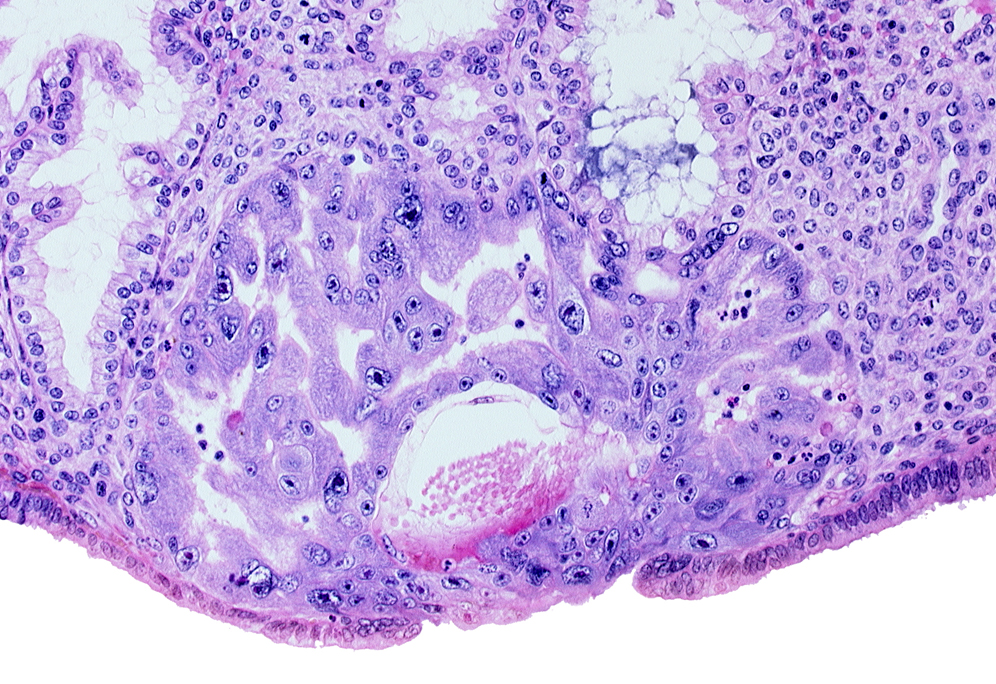 cytotrophoblast, disrupted endometrial epithelium, extra-embryonic mesoblast, intact endometrial epithelium, lumen of endometrial gland, primary umbilical vesicle cavity