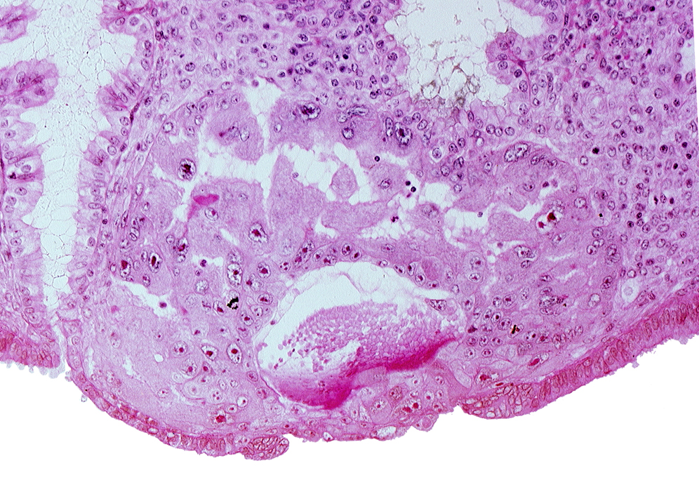 cytotrophoblast, disrupted endometrial epithelium, intercommunicating lacunae, maternal blood cells in primary umbilical vesicle cavity, mouth of endometrial gland, syncytiotrophoblast