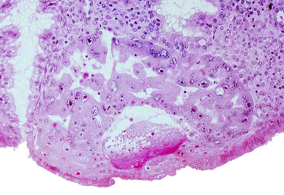 cytotrophoblast, disrupted endometrial epithelium, endometrial sinusoid, junction of endometrial sinusoid and trophoblastic lacuna, lumen of endometrial gland, maternal blood cells in primary umbilical vesicle cavity, mouth of endometrial gland, syncytiotrophoblast