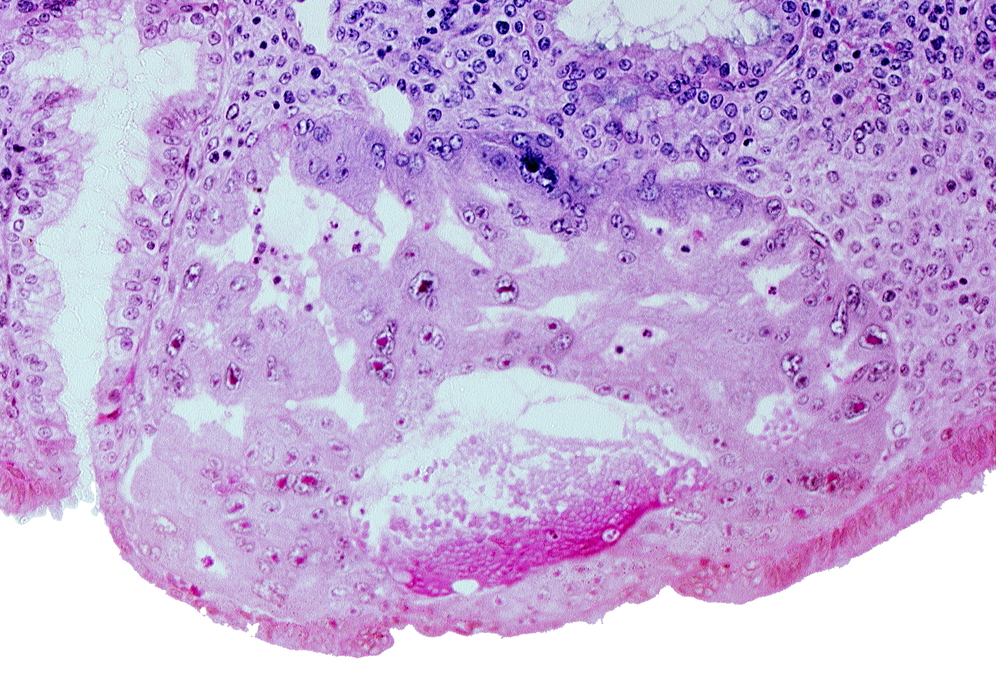 cytotrophoblast, disrupted endometrial epithelium, lumen of endometrial gland, maternal blood cells in primary umbilical vesicle cavity, syncytiotrophoblast