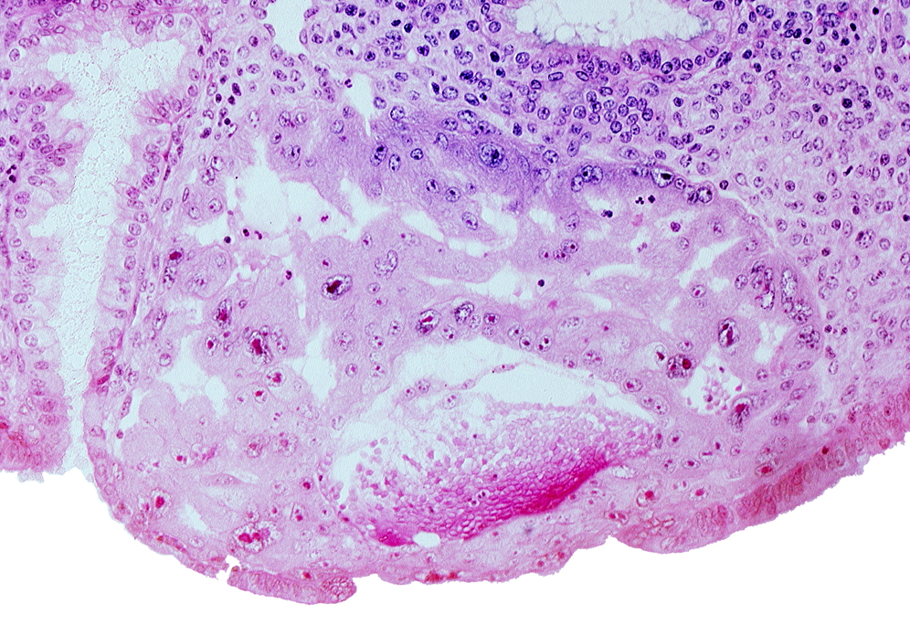 disrupted endometrial epithelium, extra-embryonic endoblast, intact endometrial epithelium, intercommunicating lacunae