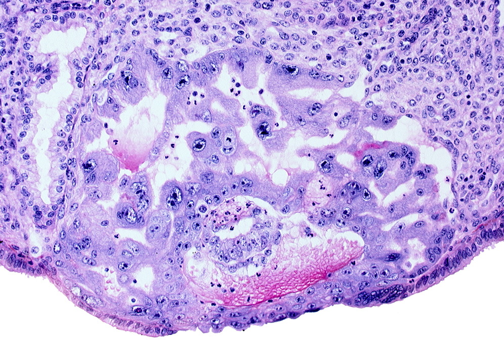 amniotic cavity, disrupted endometrial epithelium, uterine cavity