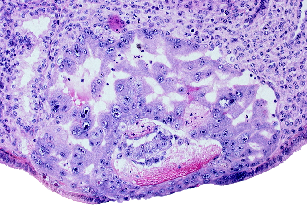 amnioblast(s), amniotic cavity, disrupted endometrial epithelium, endometrial sinusoid, epiblast, extra-embryonic endoblast, hypoblast, uterine cavity