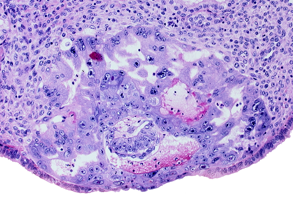amnioblast(s), amniotic cavity, cytotrophoblast, disrupted endometrial epithelium, endometrial sinusoid, epiblast, intact endometrial epithelium, intercommunicating trophoblastic lacunae, syncytiotrophoblast, uterine cavity