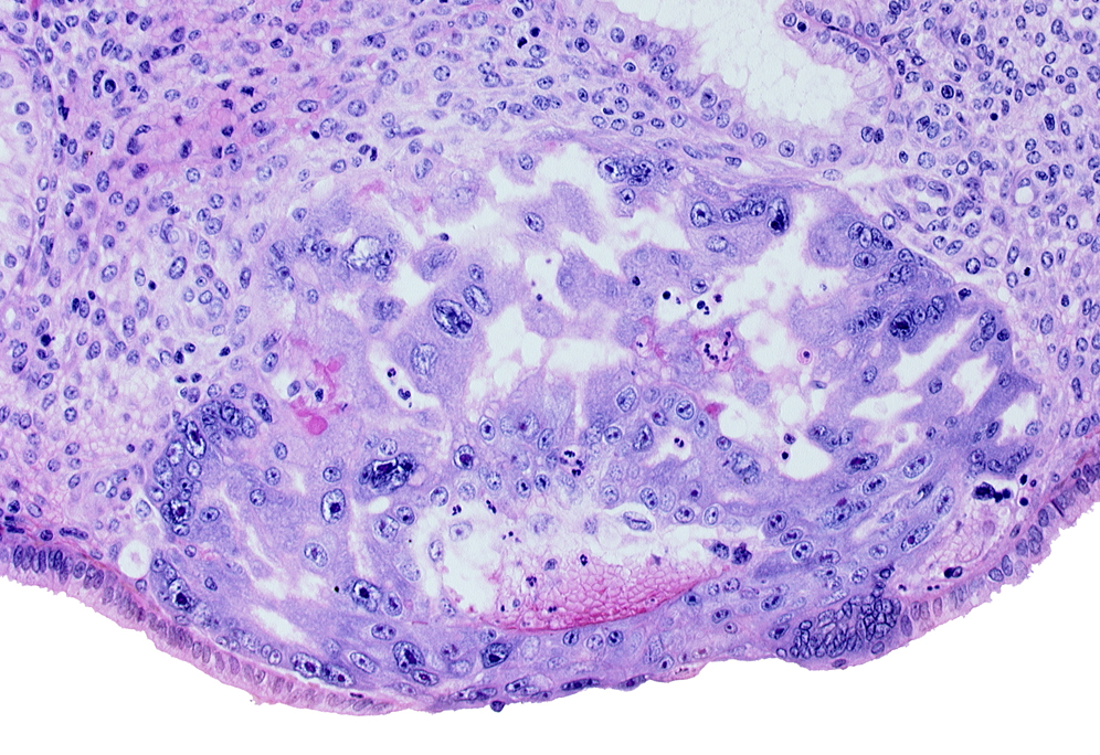 cytotrophoblast, edge of embryonic disc, extra-embryonic endoblast, maternal blood cells in primary umbilical vesicle cavity, primary umbilical vesicle cavity