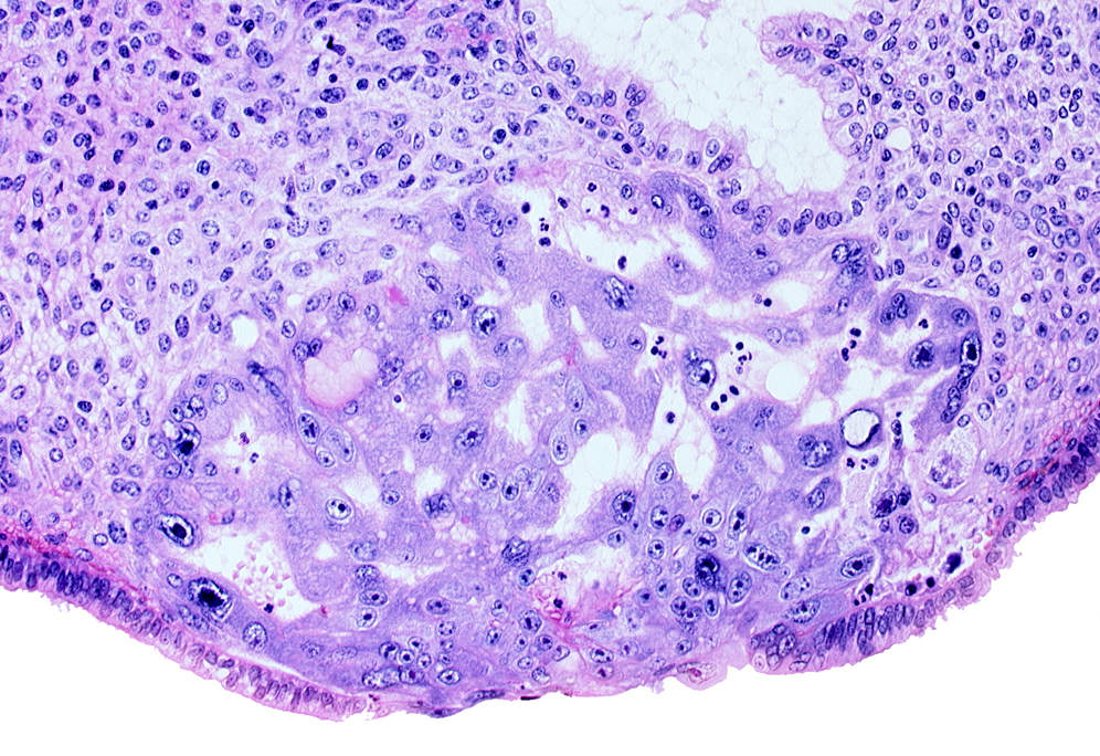 disrupted endometrial epithelium, intact endometrial epithelium, intercommunicating lacunae, lumen of endometrial gland