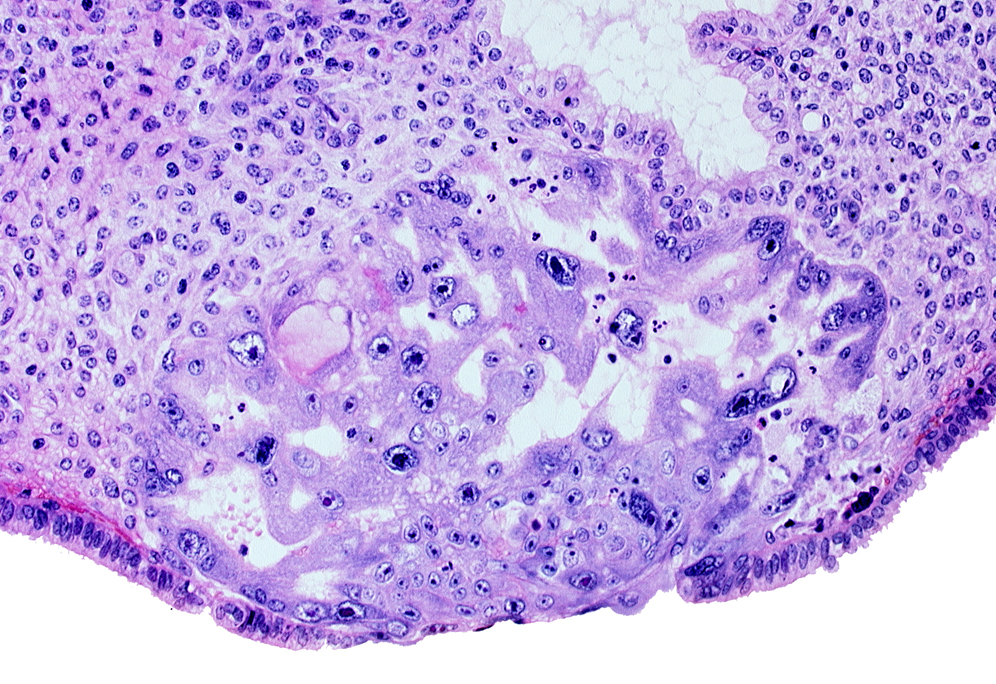 cytotrophoblast, disrupted endometrial epithelium, endometrial stroma, intact endometrial epithelium, intercommunicating lacunae, lumen of endometrial gland, syncytiotrophoblast
