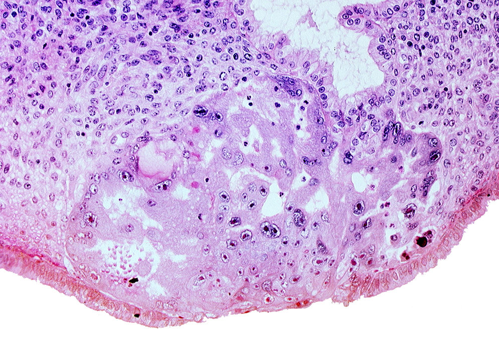 disrupted endometrial epithelium, edematous endometrial stroma (decidua), endometrial gland, intact endometrial epithelium, syncytiotrophoblast, uterine cavity