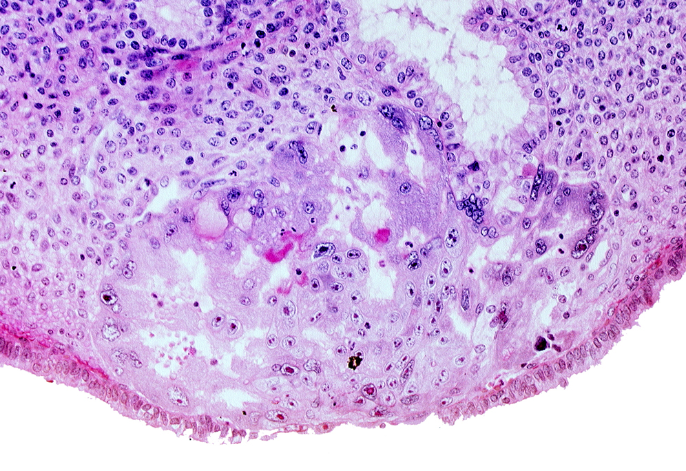 disrupted endometrial epithelium, intercommunicating lacunae, lumen of endometrial gland, syncytiotrophoblast, uterine cavity