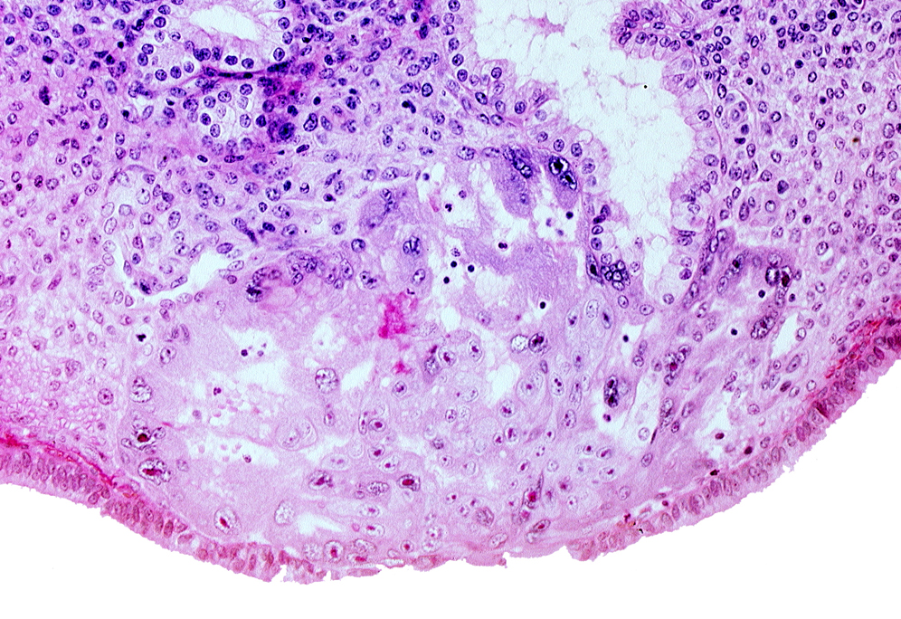 disrupted endometrial epithelium, lumen of endometrial gland, maternal blood cells in lacunae