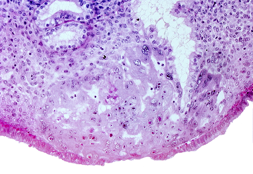 disrupted endometrial epithelium, endometrial epithelium, endometrial gland, lumen of endometrial gland