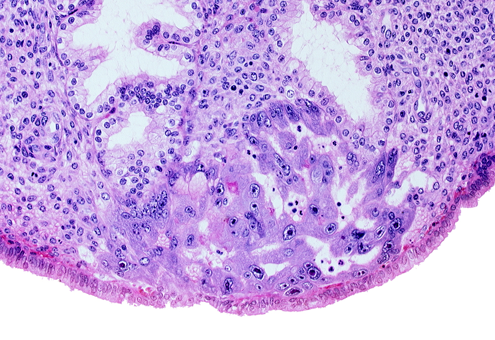endometrial sinusoid, intact endometrial epithelium, lumen of endometrial gland, uterine cavity